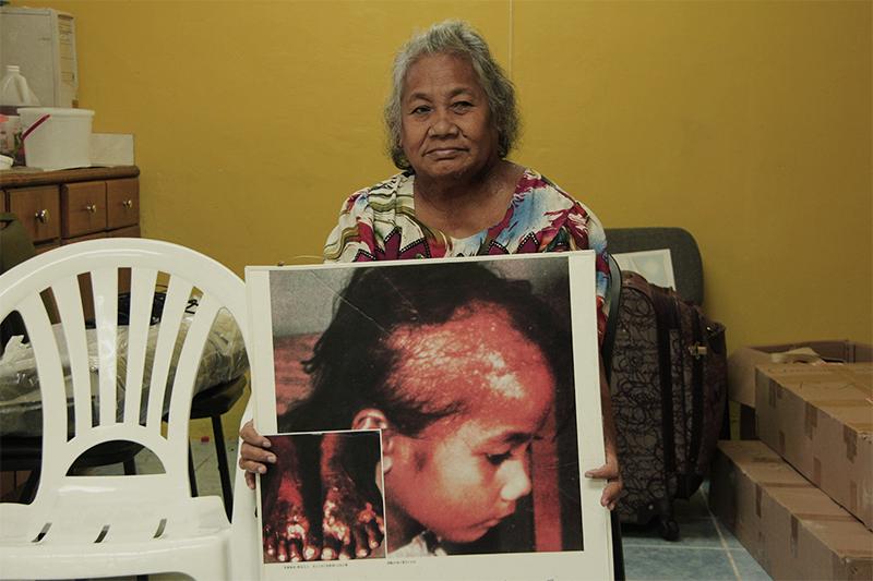 A Marshallese woman with a photo of radiation burns